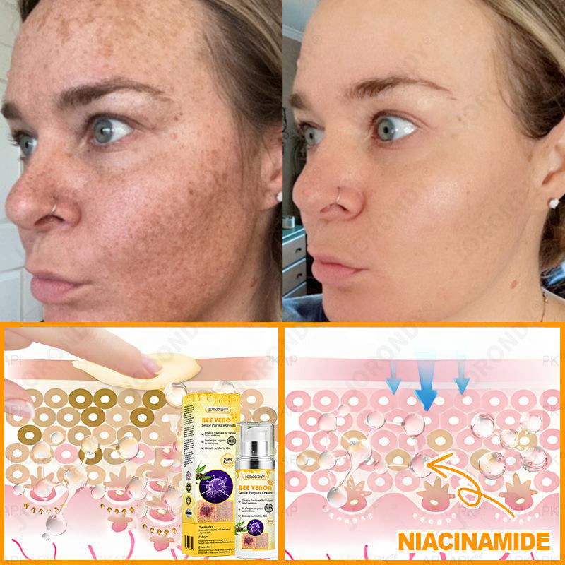 🐝 JORONDY® Bee Venom Senile Purpura Cream:Still struggling? Get a Second Box at an extra 30% Off – One for Home, One for On-the-Go!