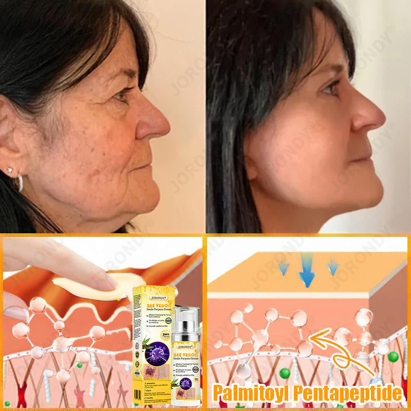 🐝 JORONDY® Bee Venom Senile Purpura Cream:Still struggling? Get a Second Box at an extra 30% Off – One for Home, One for On-the-Go!
