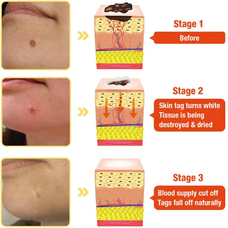 Jorondy® TagRecede Bee Venom Treatment Cream