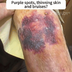 🐝 JORONDY® Bee Venom Senile Purpura Cream:Still struggling? Get a Second Box at an extra 30% Off – One for Home, One for On-the-Go!