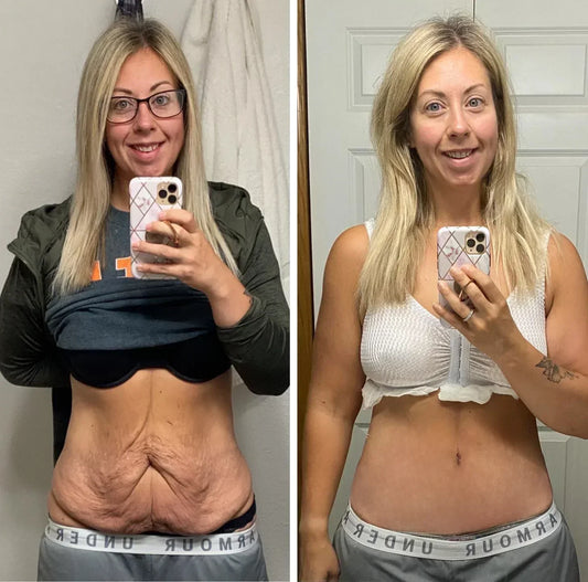 Refuse the scalpel! A mother of two uses this cream to smooth out her flabby post-partum belly and age in 60 days!