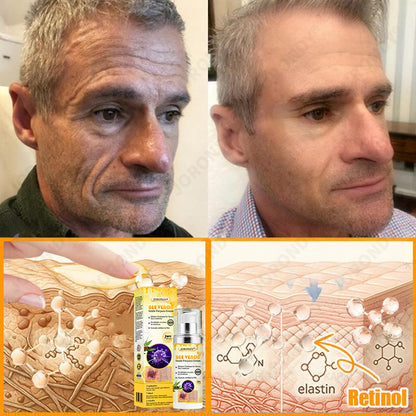 🐝 JORONDY® Bee Venom Senile Purpura Cream:Still struggling? Get a Second Box at an extra 30% Off – One for Home, One for On-the-Go!