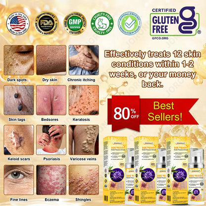 🐝 JORONDY® Bee Venom Senile Purpura Cream:Still struggling? Get a Second Box at an extra 30% Off – One for Home, One for On-the-Go!