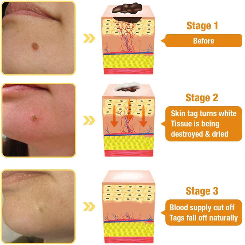 Jorondy® TagRecede Bee Venom Treatment Cream