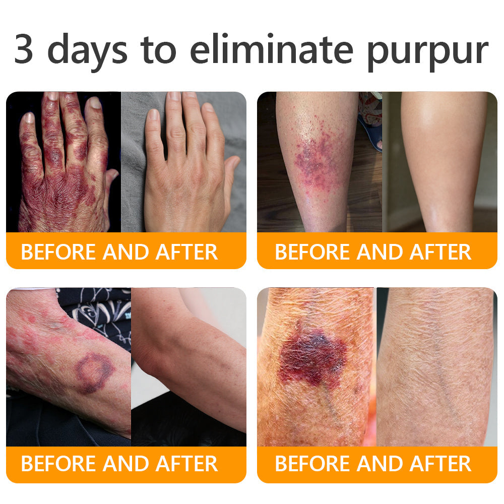 🐝 JORONDY® Bee Venom Senile Purpura Cream:Still struggling? Get a Second Box at an extra 30% Off – One for Home, One for On-the-Go!