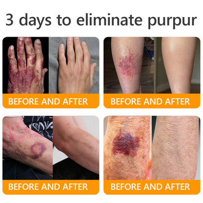 🐝 JORONDY® Bee Venom Senile Purpura Cream:Still struggling? Get a Second Box at an extra 30% Off – One for Home, One for On-the-Go!